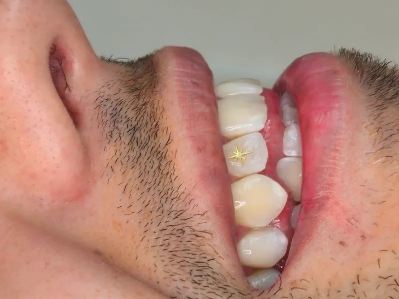 Gold star tooth gem placement